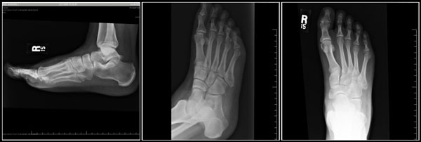 metatarsal
